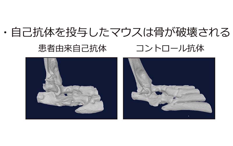 自己免疫疾患患者で誘導される自己抗体が持つ病原性の解析